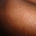 measles-648479_960_720