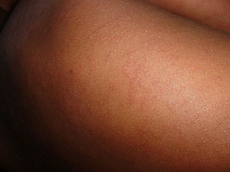 measles-648479_960_720