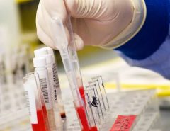 Alzheimer: exame de sangue pode detectar a doença vinte anos antes.