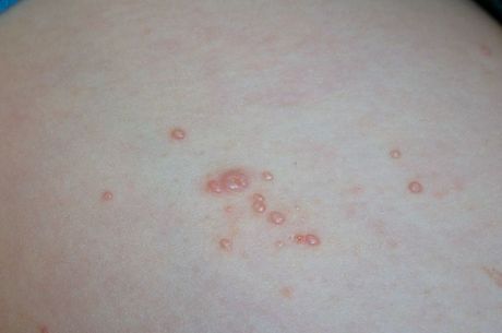 molusco-contagioso-07102019102848338