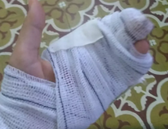 Covardia: Bandidos cortam dedo de mulher com foice em arrastão no Seridó