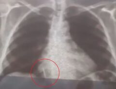 Incrível: Broca de dentista se solta durante atendimento e vai parar em de pulmão de paciente no interior do RN