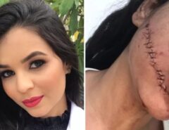 ‘Lembrança eterna’, diz jovem que teve o rosto cortado em viagem de ónibus