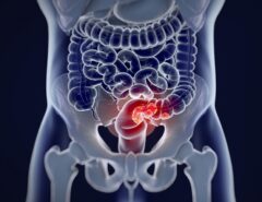 FIQUE LIGADO: Veja sinais do câncer de intestino, cada vez mais comum antes dos 50 anos