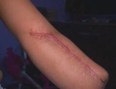 Mulher vai a hospital no Rio para dar à luz e sai com mão amputada