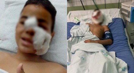 BRASIL: Criança de 10 anos tem orelha decepada ao ser atacada por pitbull