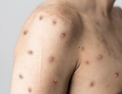 DESCARTADO: Sesap descarta caso de monkeypox em Mossoró